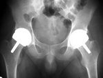 Hip Resurfacing done at Chennai for 23 yr Male (M) patient with Bilateral AVN