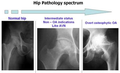 Hip Pathology spectrum