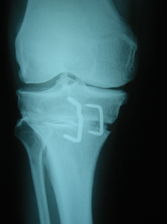 Osteotomy