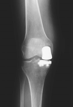 Total Knee Replacement